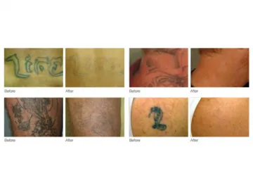 Nd: Yag Laser (Tattoo Removal)