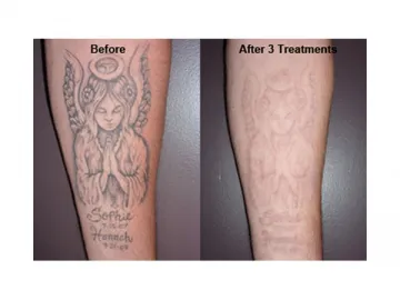 Tattoo Removal