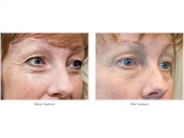 Skin Tightening