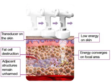 HIFU(High-Intensity Focused Ultrasound) Treatment