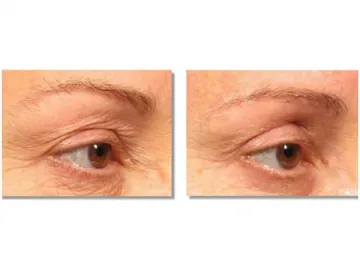 Wrinkle Removal and Skin Rejuvenation